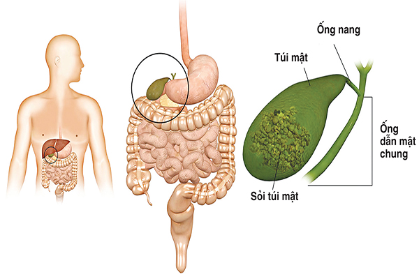 Sỏi mật do đâu mà có?