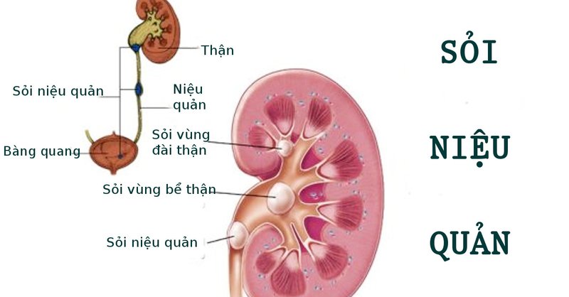 SỎI NIỆU QUẢN