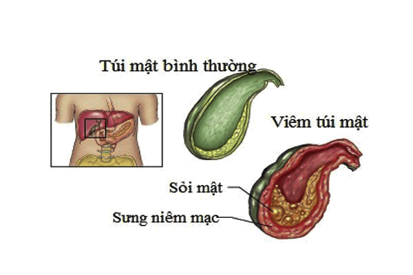 Bệnh viêm túi mật là gì? – Độ tuổi thường mắc bệnh?